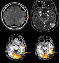 Sprach-Aktivierung bei Epilepsie-auslösendem Tumor im hinteren Schläfenlappen. Sprach-Aktivierung bei Epilepsie-auslösendem Tumor im hinteren Schläfenlappen.