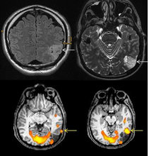Sprach-Aktivierung bei Epilepsie-auslösendem Tumor im hinteren Schläfenlappen.