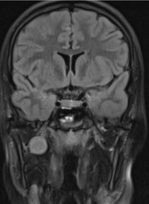 Jugendliche mit Schwannom am N. alveolaris inferior (Unterkiefernerv)