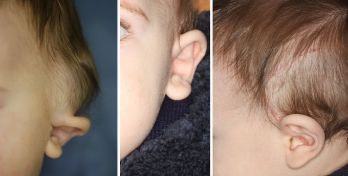 8 Monate altes Kind mit Raumforderung am linken Ohr
