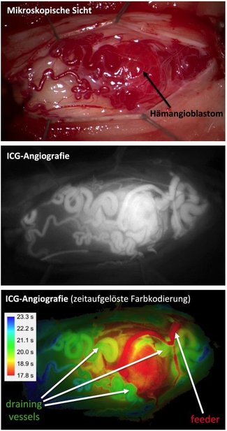 Intraoperative Gefäßdarstellung (ICG-Angiografie)