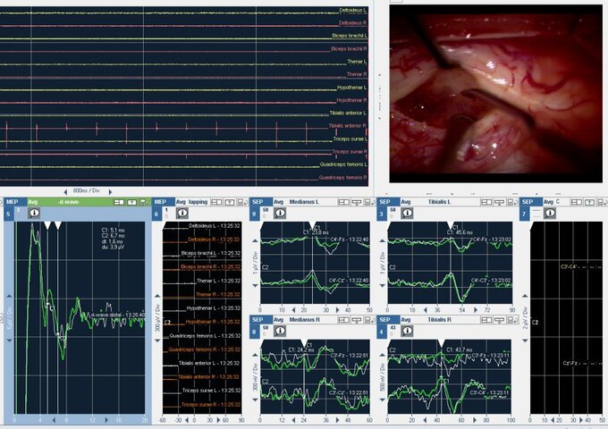 Intraoperatives Neuromonitoring