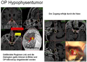 Surgery of brain tumour