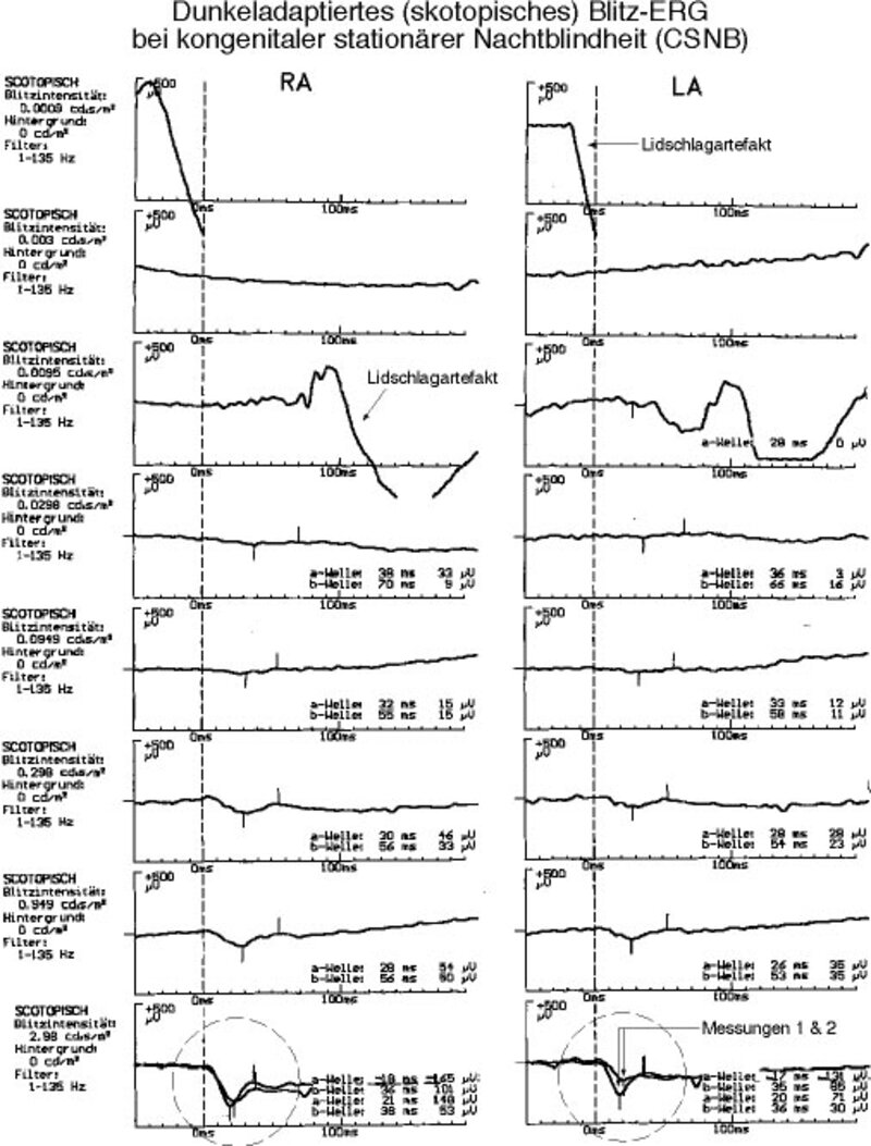 Skotopisches Blitz-ERG bei kongenitaler stationärer Nachtblindheit. 