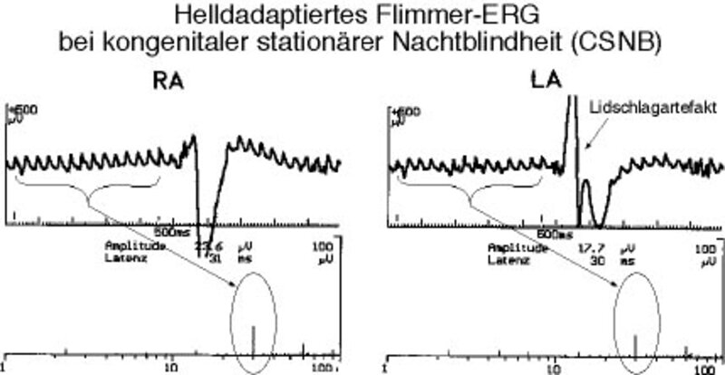 Photopisches Blitz-ERG bei kongenitaler stationärer Nachtblindheit.
