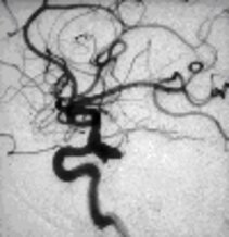 Angiographic view of an aneurysm