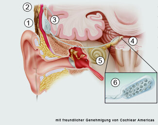 How the auditory brainstem implant works