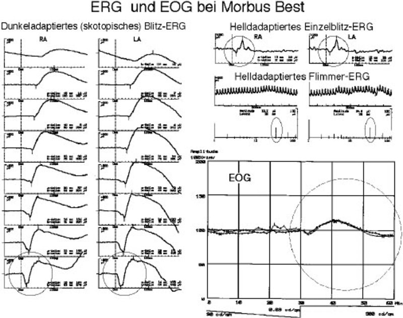 ERG und EOG bei M. Best.