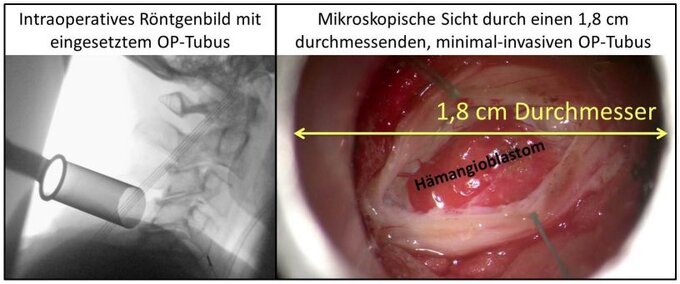 Minimal-invasive Operationstechniken