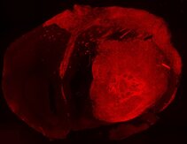 Brain tumor formation Brain tumor formation