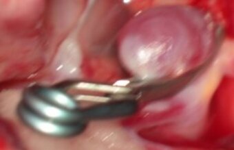 Microsurgical treatment by clipping