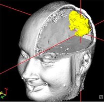 Tumorlokalisation mittels Neuronavigation