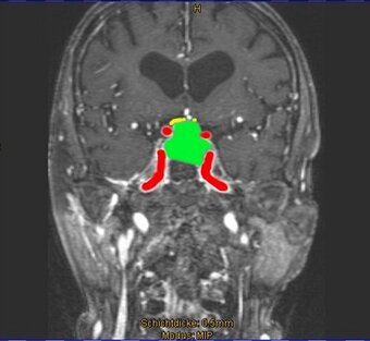 Kernspintomographisches Bild eines Hypophysenadenoms