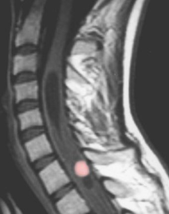 hemangioblastoma of the spinal cord