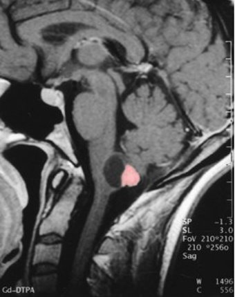 hemangioblastoma in the cerebellum
