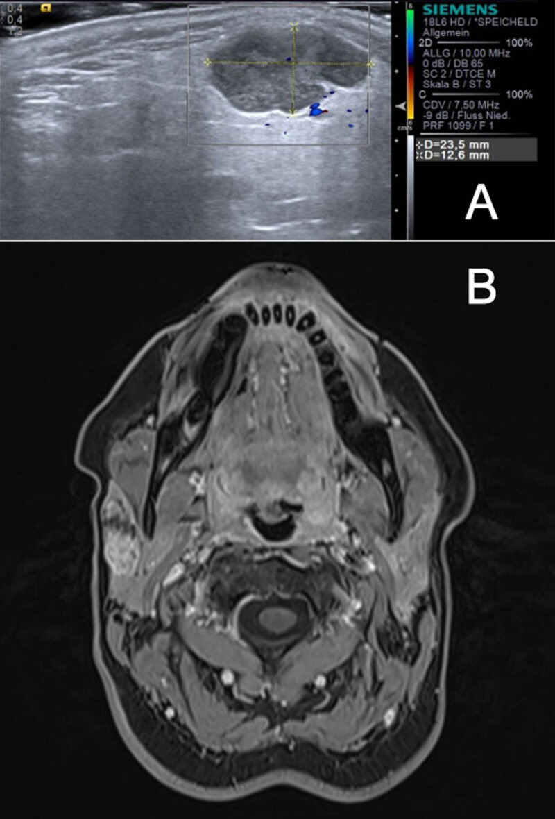 Bild 2: Ultraschall (a) sowie strahlungsarme MRT-Untersuchung eines pleomorphen Adenomes im Bereich der Glandula parotidea rechts.