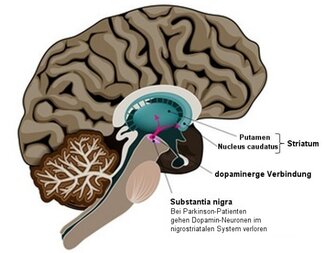 Parkinson's Disease © designua, fotolia