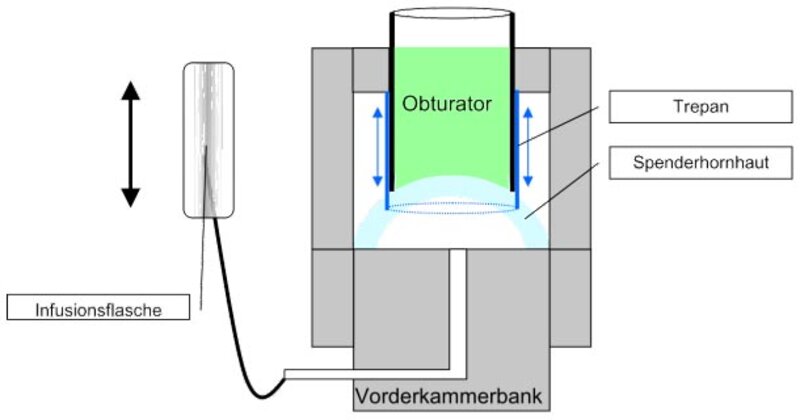 Prinzip des geführten Trepansystems