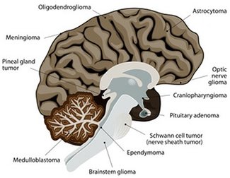 most common primary brain tumors © designua, Fotolia