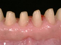 Die Zähne wurden durch einen sogenannten apikalen Verschiebelappen verlängert.