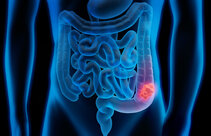 Colorectal Cancer Awareness Month in March serves as a reminder of how important screenings are. A colonoscopy, in particular, can detect and remove precancerous lesions before a tumor even develops. ©Fotolia