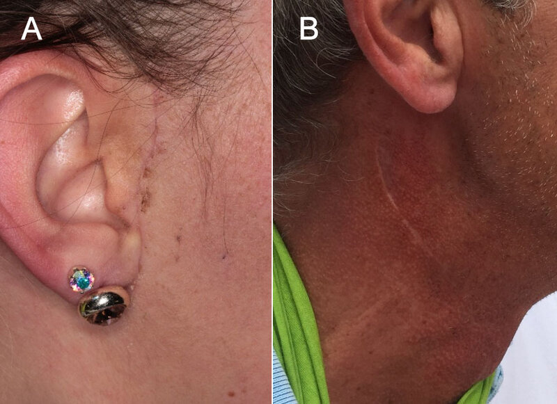 Bild 3: Postoperative Bilder nach Entfernung von großen pleomorphen Adenomen der Glandula parotidea über präaurikuläre (a) bzw. retroaurikuläre (b) Zugangswege.