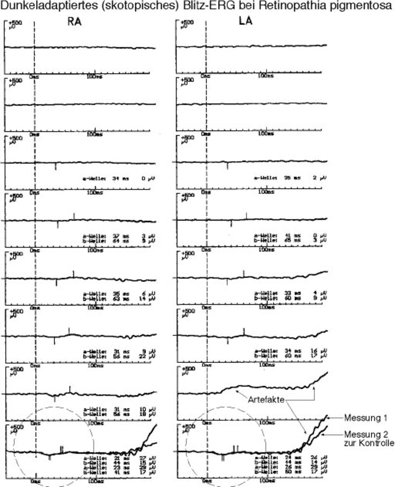 Skotopisches Blitz-ERG bei Retinopathia pigmentosa.