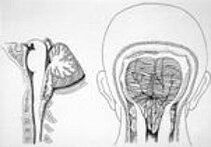 Chiari malformation type I