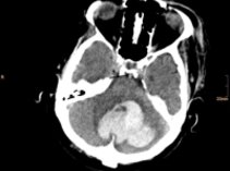 Intracerebral hemorrhage before surgical treatment