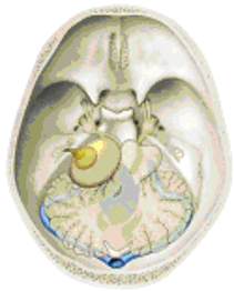 Figure 2: tumor in the cerebellopontine angle