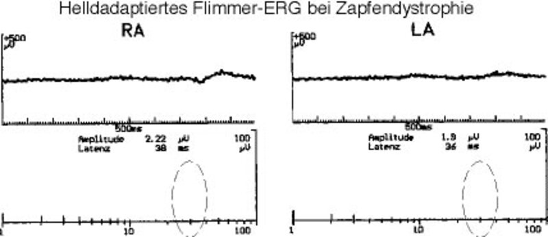 Photopisches Blitz-ERG bei Zapfendystrophie