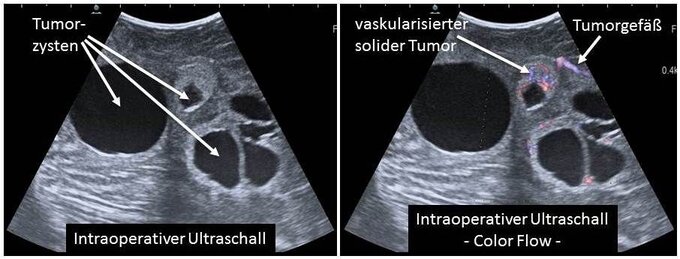 Intraoperativer Ultraschall Intraoperativer Ultraschall