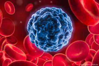 Krebszelle umgeben von roten Blutkörperchen. Bei einer Leukämie kommt es zu einer übermäßigen Vermehrung der weißen Blutkörperchen. 