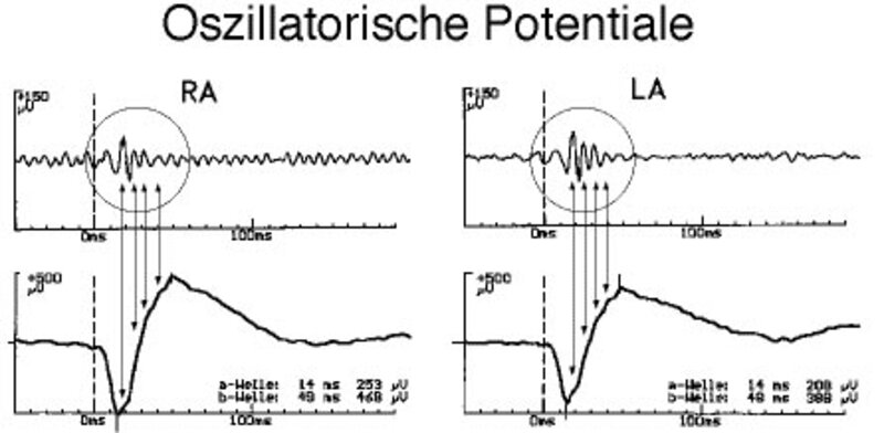 Normale oszillatorische Potentiale.