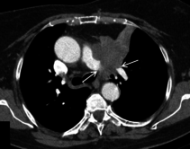 Computertomographie einer Patientin mit einem Lungenkarzinom