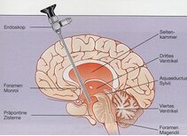 Endoscopic ventriculo cisternostomy