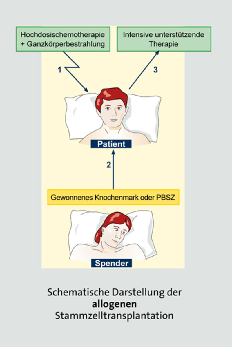 Allogene Stammzelltransplantation