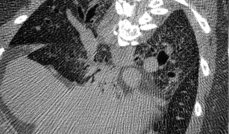 Mouse Lung scanned with SkyScan 1276