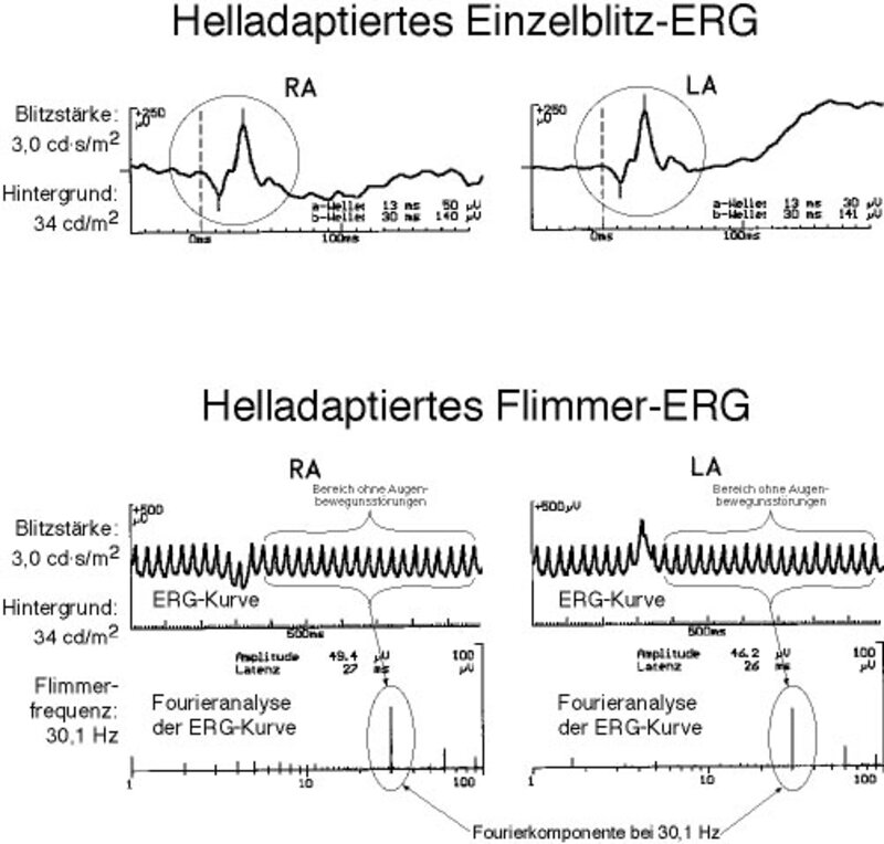 Normales helladaptiertes (‘photopisches’) Blitz-ERG, Zapfensignale. 