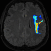 Faserbahndarstellung der Verbindung zwischen beiden Sprachzentren bei einer fokalen Fehlbildung)  im Stirnlappen