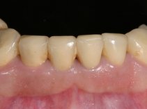 Zustand der zu kurzen Zähne vor Eingriff