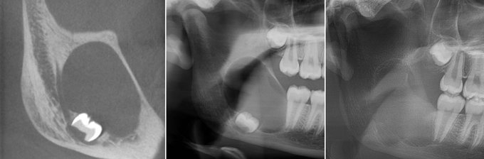 14 Jährige mit Raumforderung Unterkiefer, Verdrängung von Zahn und Nerv, Bilder präoperativ und 3 Monate postoperativ
