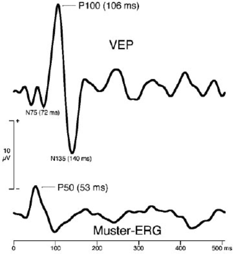 Normales Muster-ERG und VEP.