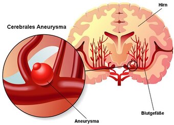 Cerebrales Aneurysma © rob3000 - fotolia