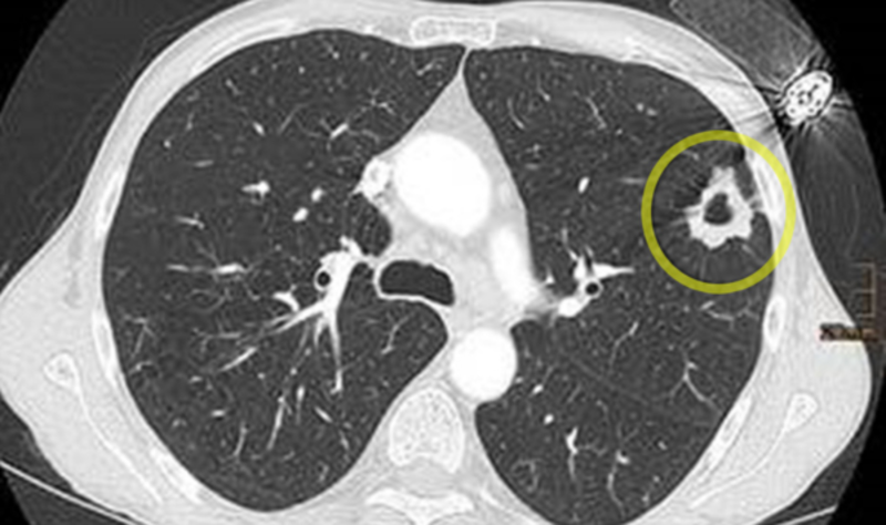 Computertomogramm der Lunge. Die Zigaretten und das Feuerzeug stecken noch in der Brusttasche. Der Tumor wächst direkt darunter in der Lunge. ©Universitätsklinikum Freiburg