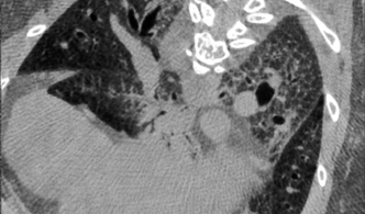 Mouse Lung scanned with SkyScan 1276