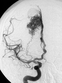 Angiographic imaging of an angioma