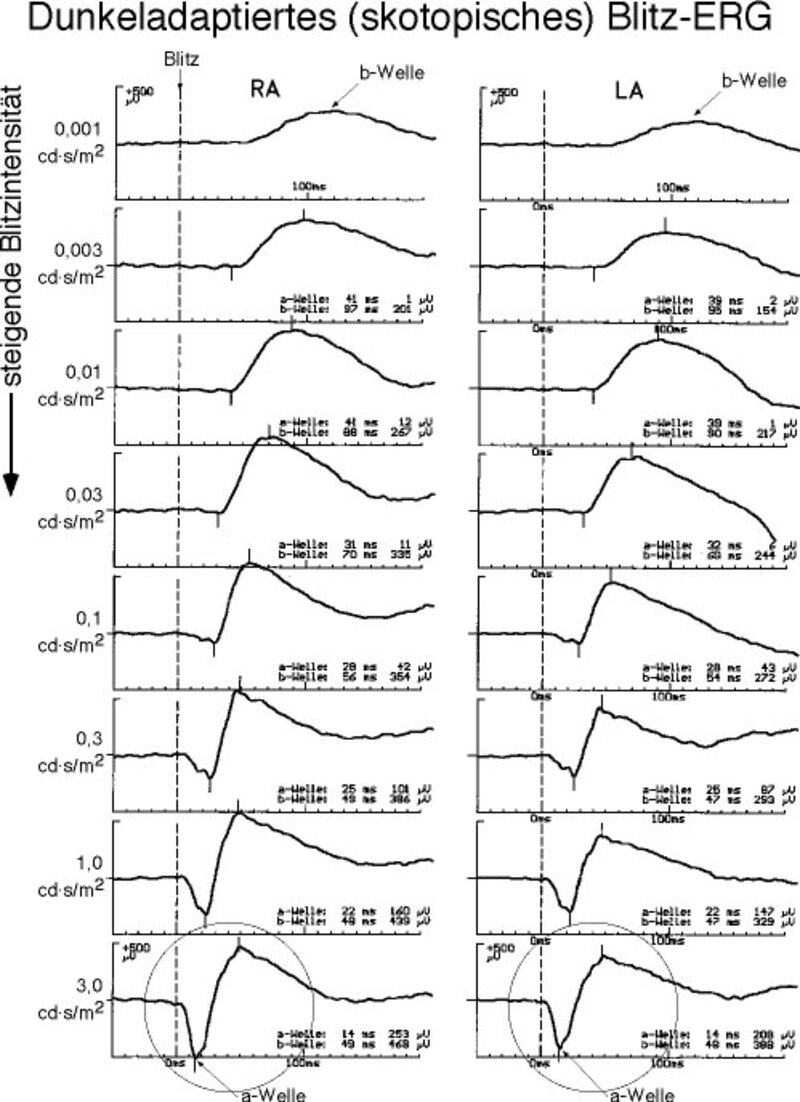 Normales dunkeladaptiertes Blitz-ERG, Stäbchensignale.