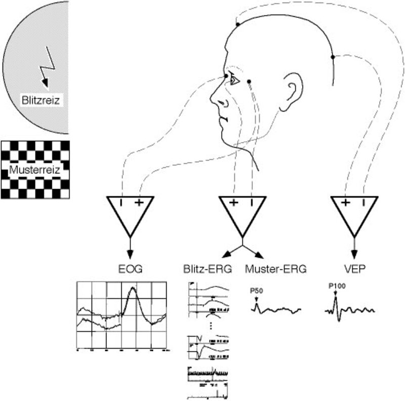 Vereinfachtes Schema elektrodiagnostischer Ableitungen. 