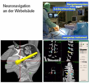 Neuro navigation in spine surgery